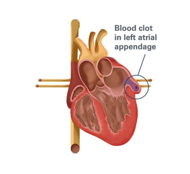 Alternative To Warfarin – Watchman Implant