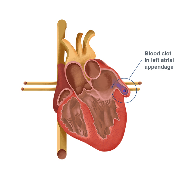 Alternative to Warfarin – WATCHMAN Implant