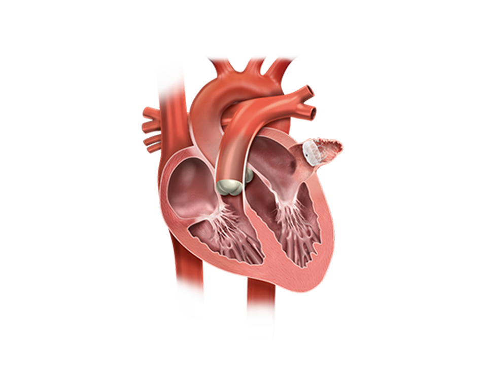 Managing AF & Stroke Risk | WATCHMAN Device