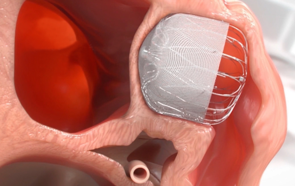 Rendering of heart tissue growing over WATCHMAN Implant.
